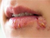 الهربس: فيروس شائع يصاحبنا مدى الحياةيُعد الهربس